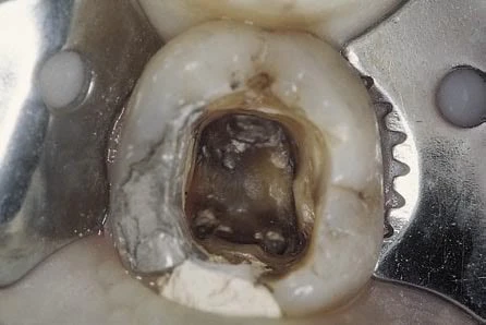 loại bỏ hoàn toàn phần tủy trên