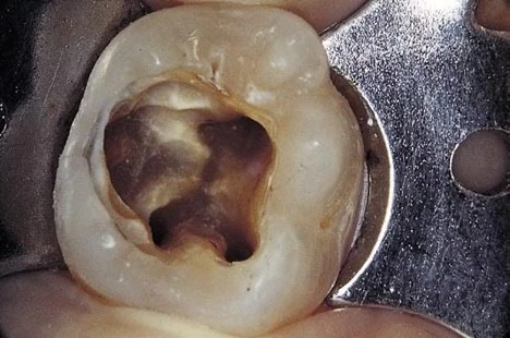 NHỮNG SAI SÓT TRONG MỞ TỦY phán đoán sai ống tủy