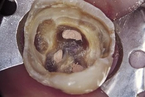 trám bít kín khít ống tủy