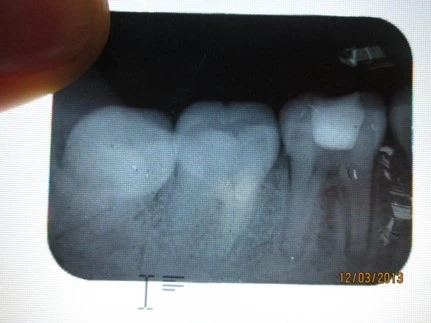 NHỮNG SAI SÓT TRONG MỞ TỦY thủng sàn tủy