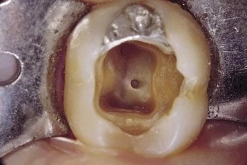 hoãn việc mở tủy