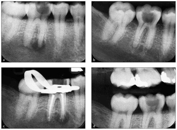 Mở tủy và định vị các lỗ ống tủy chân răng và ống tủy