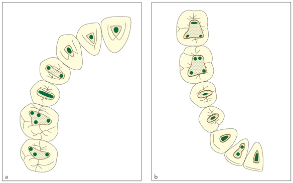 Mở tủy và định vị các lỗ ống tủy đối với răng sau