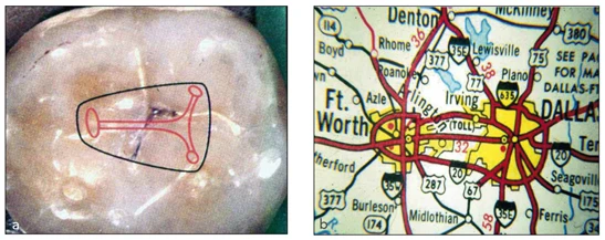 Mở tủy và định vị các lỗ ống tủy, chiến lược vươn tới chóp răng