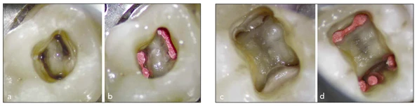 giải phẫu tủy răng
