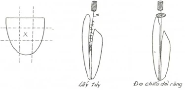 lấy buồn tủy trạm nám