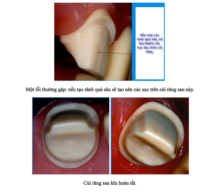 Các đường hoàn tất trong phục hình răng cac-loai-duong-hoan-tat
