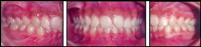 phan-loai-sai-khop-can-cua-angle