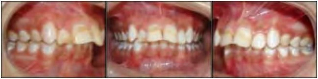 phan-loai-sai-khop-can-cua-angle