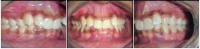 phan-loai-sai-khop-can-cua-angle