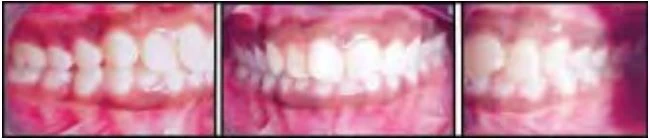 phan-loai-sai-khop-can-cua-angle