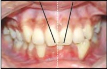 phan-loại-sai-khop-can