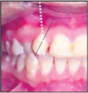 phan-loại-sai-khop-can