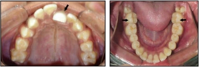 phan-loại-sai-khop-can