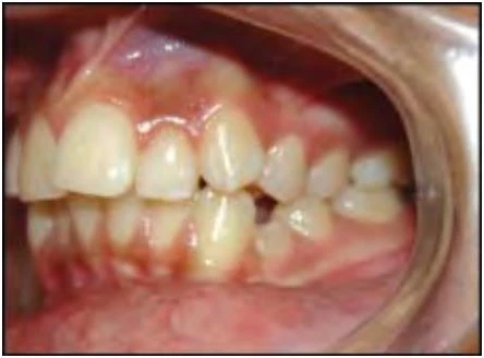 phan-loại-sai-khop-can