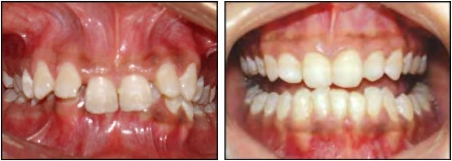 phan-loại-sai-khop-can