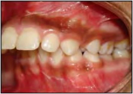 phan-loại-sai-khop-can