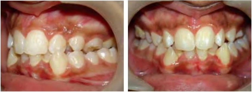 phan-loại-sai-khop-can