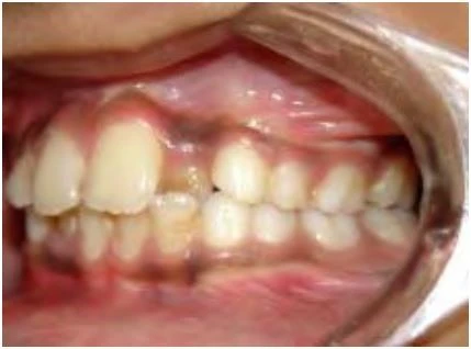 phan-loại-sai-khop-can