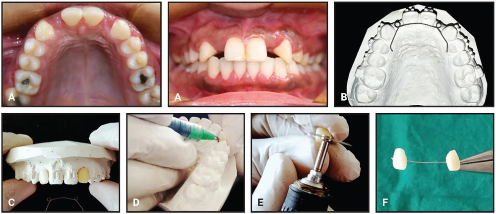 Duy trì cố định có cầu dán