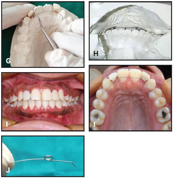 Duy trì cố định có cầu dán 2