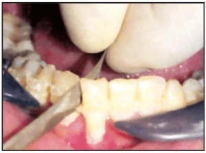 Phương pháp tạo khoảng mài kẽ trong chỉnh nha dải kim loại mài kẽ