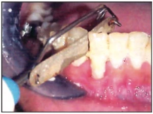 Phương pháp tạo khoảng mài kẽ trong chỉnh nha dải cây nài kẽ