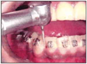 mũi khoan kim cương min mảnh