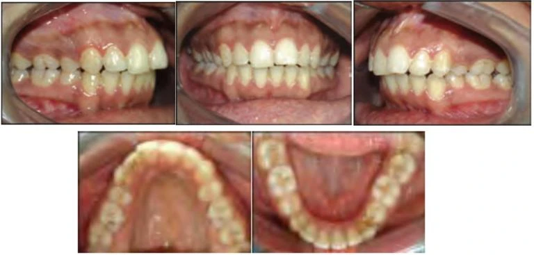 Duy trì và tái phát trong chỉnh nha (Phần 1) 1