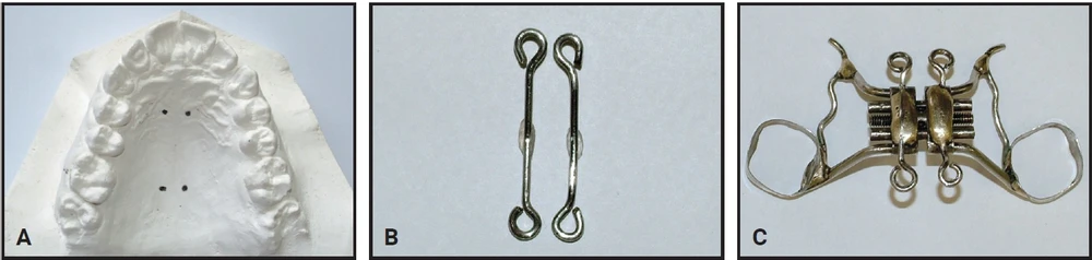 Chế tạo hàm nong nhanh hỗ trợ bởi minivis đơn giản ngay tại phòng khám che-tao-ham-nong