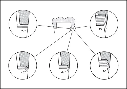 CÁC NGUYÊN TẮC MÀI CÙI RĂNG 