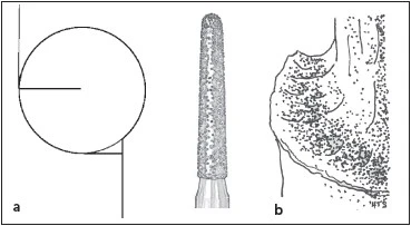 CÁC NGUYÊN TẮC MÀI CÙI RĂNG 