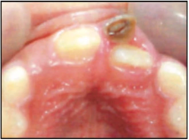 PHẪU THUẬT TRONG CHỈNH NHA (P2) - THỦ THUẬT TRÊN MÔ CỨNG RĂNG SỮA