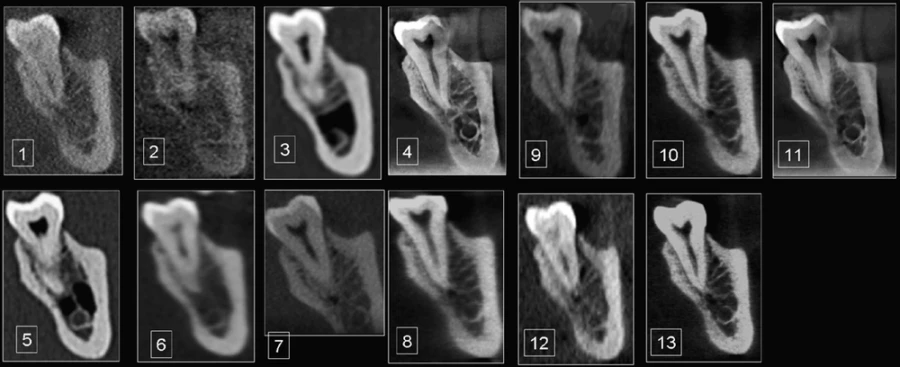 So sánh chất lượng một số loại CBCT và multislice CT trong nha khoa - 215 file