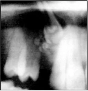 PHẪU THUẬT TRONG CHỈNH NHA (P2) - THỦ THUẬT TRÊN MÔ CỨNG RĂNG KẾ CẬN