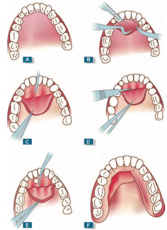 QUY TRÌNH PHẪU THUẬT RĂNG
