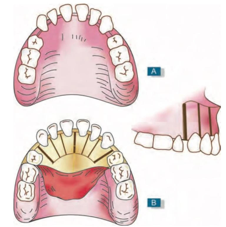 PHẪU THUẬT TRONG CHỈNH NHA (P2) - THỦ THUẬT TRÊN MÔ CỨNG CẤY CHUYỂN RĂNG