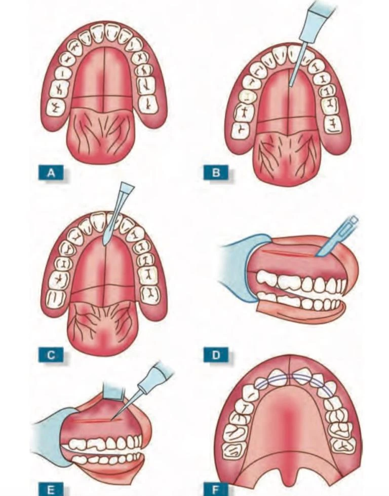 NHỔ RĂNG TỰ TUẦN