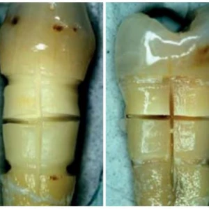 Sửa đổi ngà răng cổ bằng Laser diode để giải mẫn cảm - 28 file