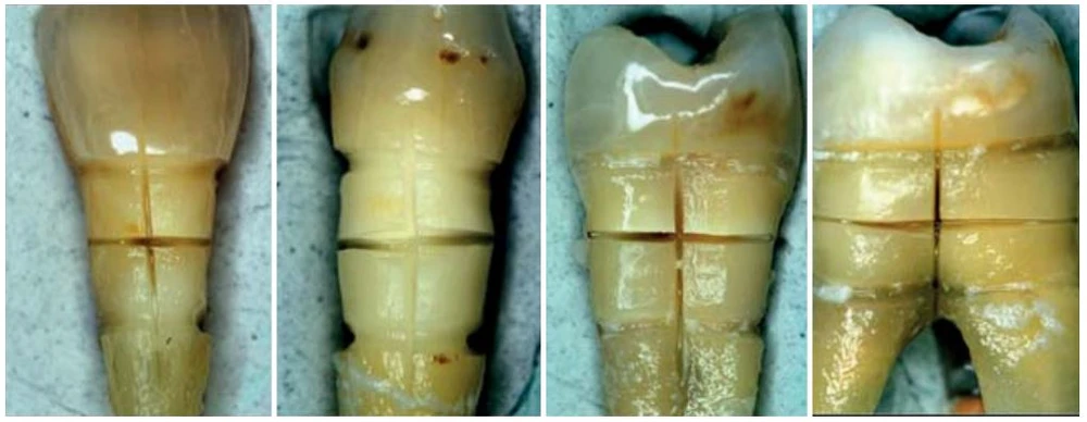 Sửa đổi ngà răng cổ bằng laser diode để giải mẫn cảm