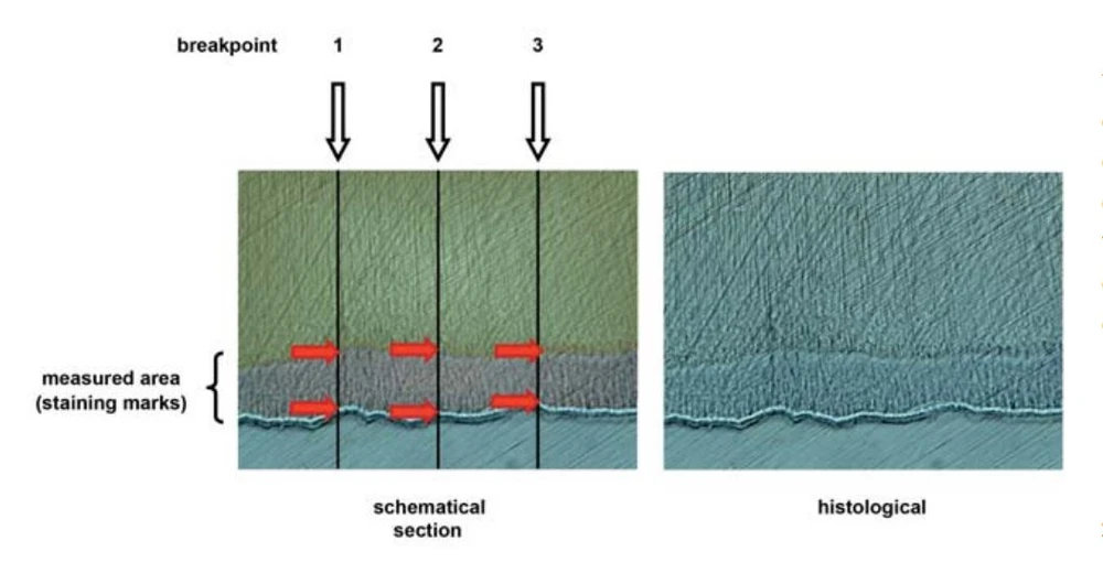 Sửa đổi ngà răng cổ bằng laser diode để giải mẫn cảm khi chiếu laser