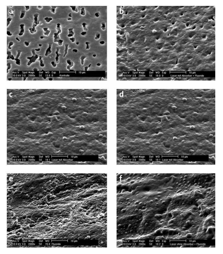 Sửa đổi ngà răng cổ bằng laser diode để giải mẫn cảm vết nứt ven viền và bề mặt
