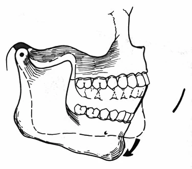 VẬN ĐỘNG BIÊN CỦA ĐIỂM RĂNG CỬA GHI TRÊN MẶT PHẲNG DỌC GIỮA(SƠ ĐỒ POSSELT) 2