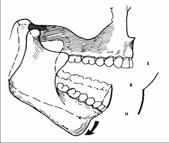 lồi cầu rời khỏi lõm khớp
