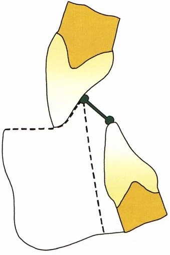 VẬN ĐỘNG BIÊN CỦA ĐIỂM RĂNG CỬA GHI TRÊN MẶT PHẲNG DỌC GIỮA(SƠ ĐỒ POSSELT) ví trí lồng múi tối đa