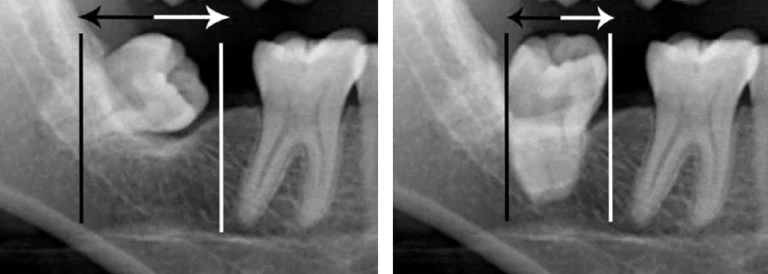 PHƯƠNG PHÁP TẠO KHOẢNG TRONG CHỈNH NHA PHẦN CUỐI
