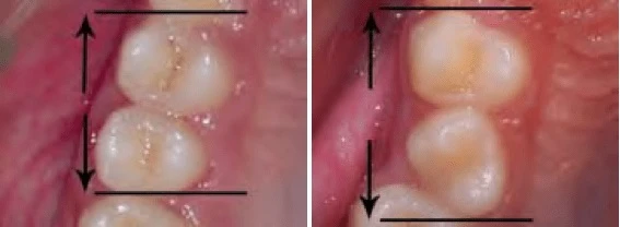 răng xoay chiếm nhiều khoảng chống hơn