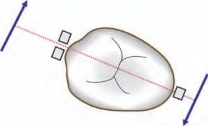 PHƯƠNG PHÁP TẠO KHOẢNG TRONG CHỈNH NHA PHẦN CUỐI cặp lực được sử dụng để xoay