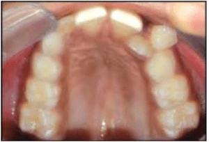 PHƯƠNG PHÁP TẠO KHOẢNG TRONG CHỈNH NHA PHẦN CUỐI RĂNG MỌC SỚM LỆCH RA