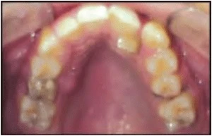 NHỔ RĂNG CỬA BÊN HÀM TRÊN